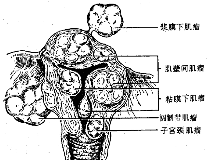 子宮肌層病變的超聲診斷