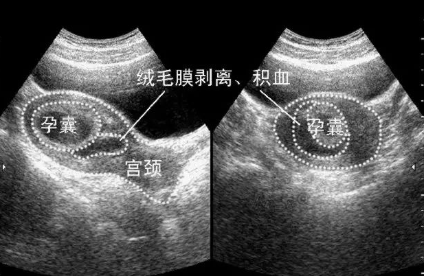 超聲如何診斷各型流產?